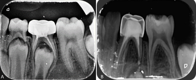 Postoperative radiographs of same teeth restored with SSC; A: Incremental technique; B: Lentulospiral technique