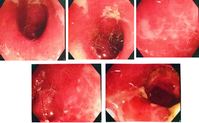 Sigmoidoscopy of descending colon and recto-sigmoid region showing multiple ulcers indicating severe colitis.