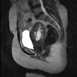 T2 sagittal section of MRI pelvis shows hyperintense areas within the thickened junctional zone representing cystic changes of Adenomyosis