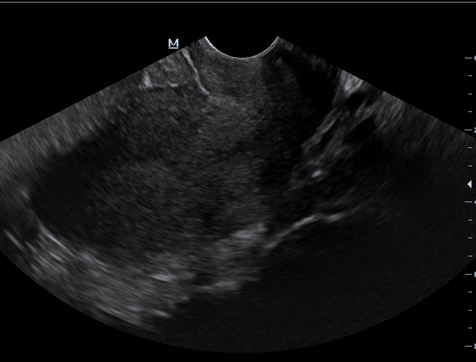 TVS image shows bulky uterus with loss of endometrial-myometrial differentiation