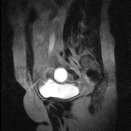 T2 sagittal section of MRI pelvis shows cystic lesion without internal septations in adnexa