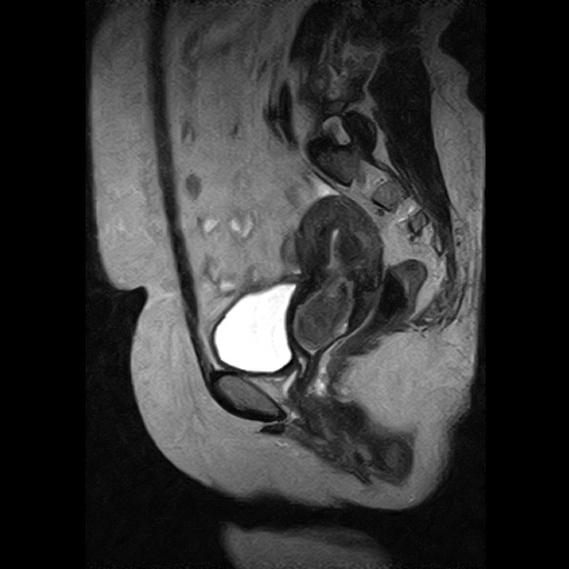 T2 sagittal section of MRI shows ovoid hypointense polyp in the endometrial cavity