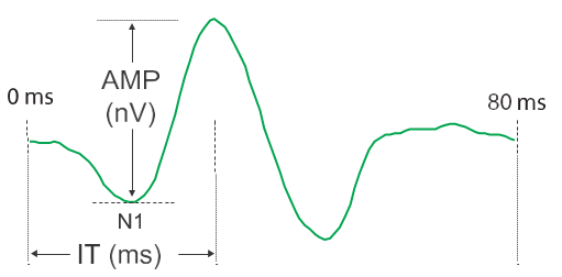 Multifocal electroretinogram (mfERG) showing Implicit time (IT) and Amplitude (AMP).