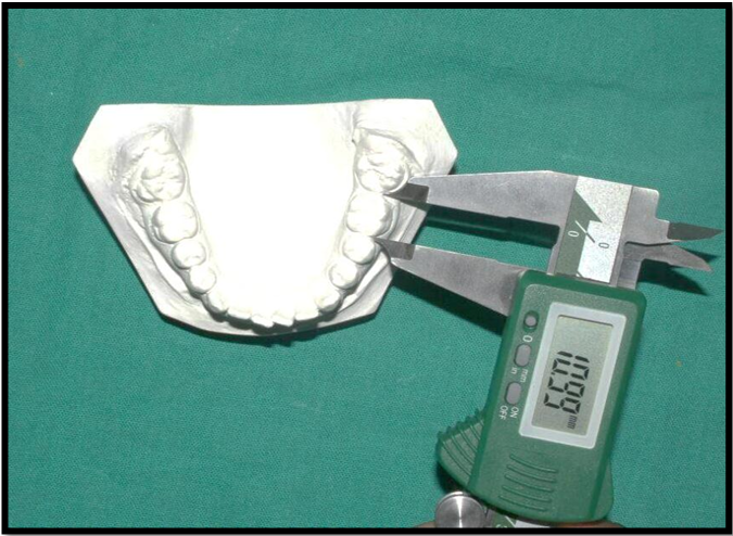 Tooth width measurement using vernier caliper