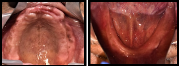 Intra- oral views of the maxillary and mandibular arches