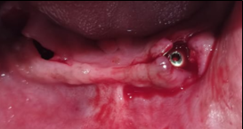 Surgical phase