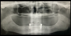 OPG post placement of gingival formers