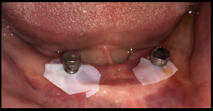 Metal housing placed (direct pick up)
