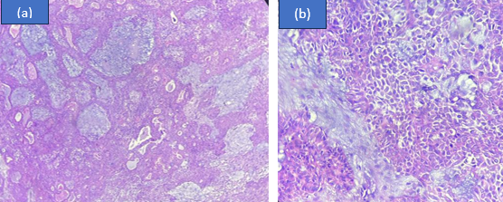 Cellular pleomorphic adenoma; (a): Chondromyxoid stroma seen at 10x magnification with nests of malignant cells; (b): Epithelial and myoepithelial nests of cells seen.