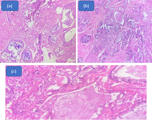 Mucoepidermoid carcinoma; (a): Mucinous pools seen along with sclerosed stroma at 4x magnification; (b): Nests of tumour cells seen at 10x magnification; (c): Pools of mucin with frosted glass appearance lined by intermediate cells at 40x magnification.