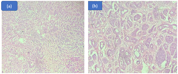 Adenoid cystic carcinoma; (a): Cribriform arrangement of tumor (10x); (b): Sharply defined round cisterns with lightly basophilic myxoid ground substance. (40x)