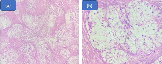 Clear cell carcinoma; (a): Diffuse sheets and nests of tumour cells separated by dense bands of sclerotic collagen; (b): Nest of clear cells comprising of neoplastic cells with abundant, clear cytoplasm with central- eccentrically placed round- oval nuclei