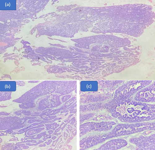 Polymorphous adenocarcinoma; (a): Storiform pattern in the periphery of tumour in 4x magnification; (b): Mucinous stroma noted in 10x magnification; (c): Neoplastic cells are small- medium sized with minimally hyperchromatic oval nuclei.