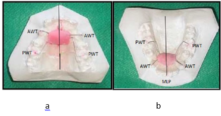 a; Maxillary acrylic plug, b; Mandibular acrylic plug