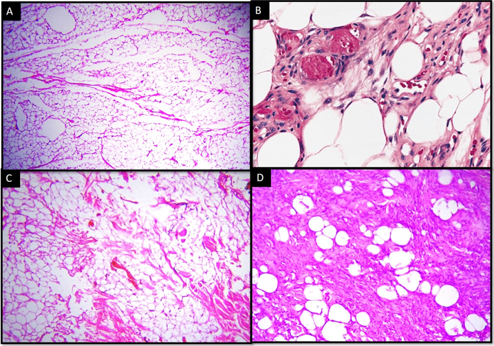 Adiocytic tumors;A: Lipoma (H & E X40); B: Angiolipoma with capillary sized blood vessels, some of which contain hyaline thrombi (H&E X100); C: Myolipoma with smooth muscle fibres (H&E X100); D: Spindle cell lipoma with spindle cell component (H&E X100)