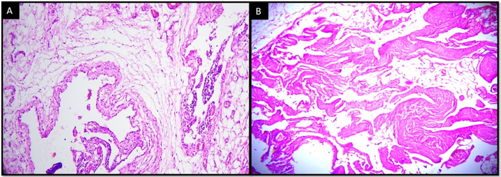 A: Lymphangioma showing multiple cystic lymphatic spaces. (H&E X100); B: Arteriovenous malformation showing thick and thin-walled vascular spaces. (H&E X100).