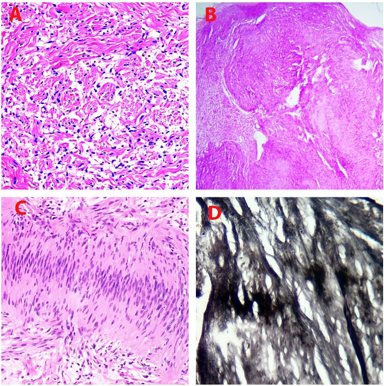 A: Neurofibroma (H&E X400); B: Plexiform Schwannoma- Nodule of uniform cellularity covered by thin fibrous capsule. (H&E X100); C: Conventional Schwannoma showing palisading of nuclei (H&E X400); D: Reticulin stain highlighting the fibrillary processes in verocay bodies in Schwannoma
