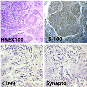 Photomicrograph of Neuroblastoma like Schwannoma showing large rosettes of tumor cells arranged around collagenous cores - (H&E X100). Immunohistochemistry images showing positive staining for S-100 and immunonegativity for CD99 and synaptophysin