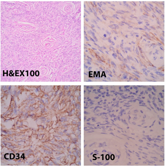 Photomicrograph of Perineurioma showing perivascular whorls of tumor cells (H&E X100). Immunohistochemistry images showing positive staining for EMA and CD34 immunonegativity for S-100