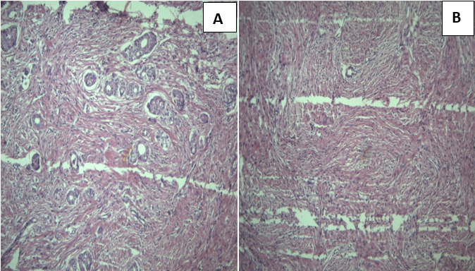 A: & B: [H &E] – showing polygonal cells with eosinophilic cytoplasm and containing multiple nucleoli