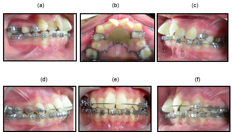 Treatment progress case-2