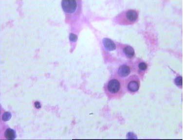 Papillary carcinoma of thyroid