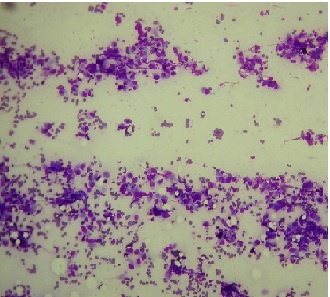 Anaplastic carcinoma of thyroid