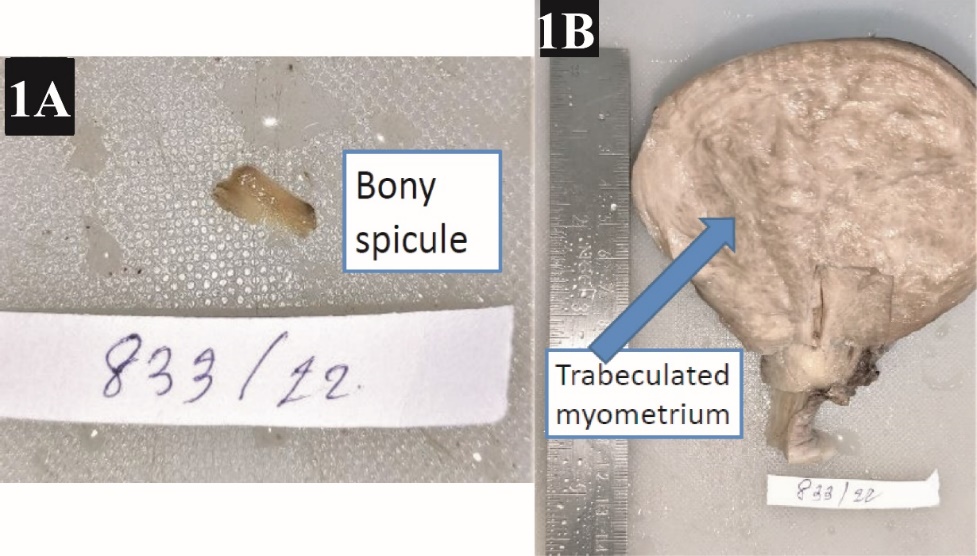 A): Bony spicule that was lying within the endometrial cavity; B): Hysterectomy specimen showing trabeculated myometrium obliterating the endometrial canal