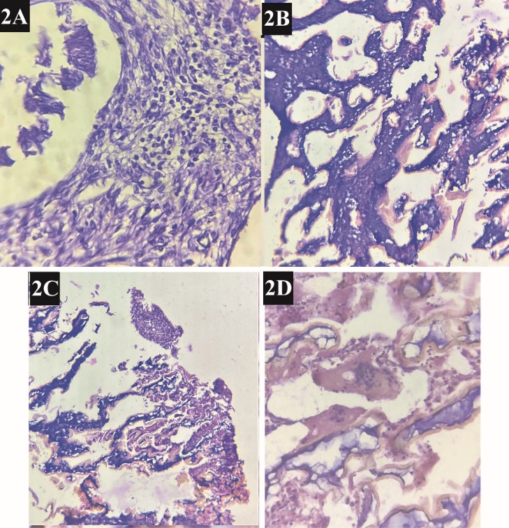 Extramedullary hematopoiesis with underlying endometritis; A): Microphotographic image showing endometrialstroma with chronic inflammatory cells consisting of lymphocytes and plasmacells. 40x H&E stain; B): Microphotographic image showing immature lamellar bone with hematopoietic cells. 10x H&E stain; C): Microphotographic image showing immature lamellar bone with hematopoietic cells. 4x H&E stain; D): Microphotographic image showing immature lamellar bone with osteoclast giant cells. 40x H&E stain