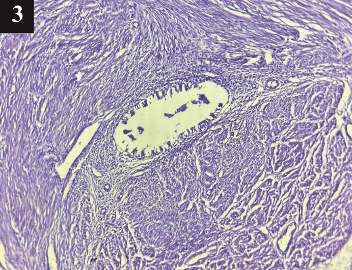 Microphotographic image showing myometrium with embedded endometrial glands and stroma. 40x H&E stain