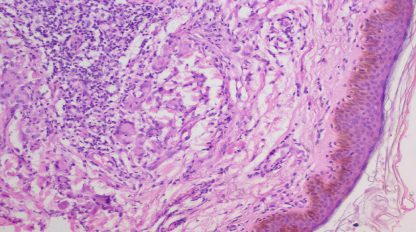 Photograph of Annular elastolytic giant cell granuloma with giant cells and lymphocytic inflammatory infiltrates (H&E 400X)