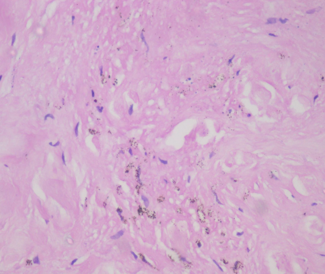 Photograph showing black tattoo pigment in extracellular areas in a case of tattoo granuloma (H&E 400X)