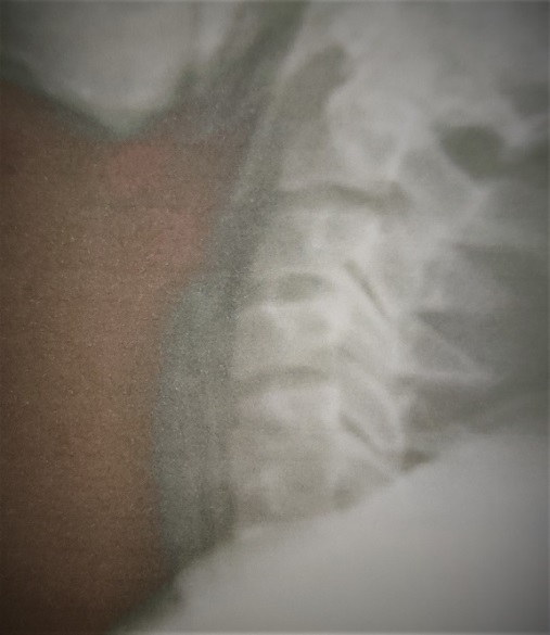 Immediate post op