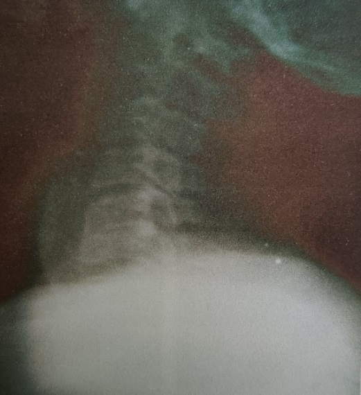 6 months follow up post-surgery