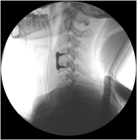 Intra operative radiograph showing graft and implant