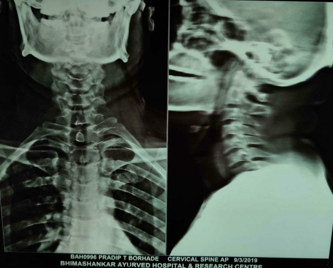 Pre-op X-ray
