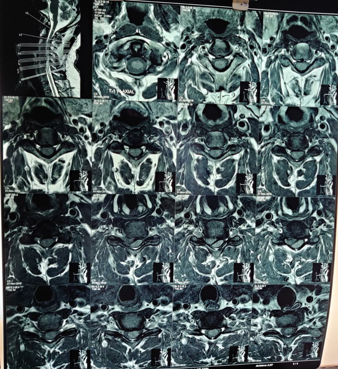 Pre-op MRI-axial cut