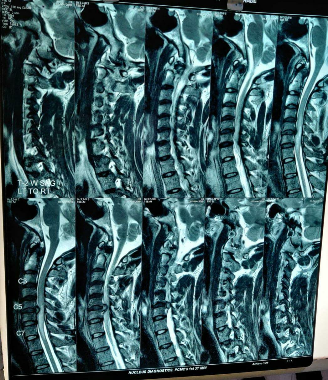 Pre-op MRI sagittal cut