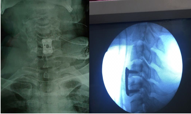 Immediate post op showing C5-C6 ACDF