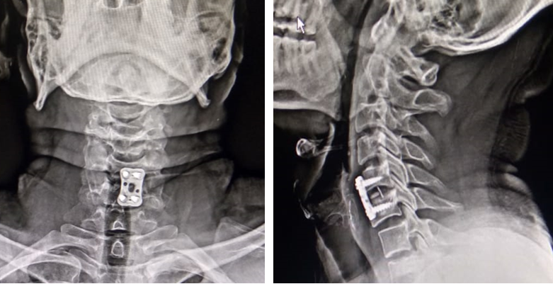 One year follow up post surgery