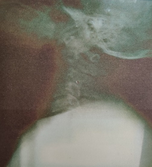 Pre op X-ray