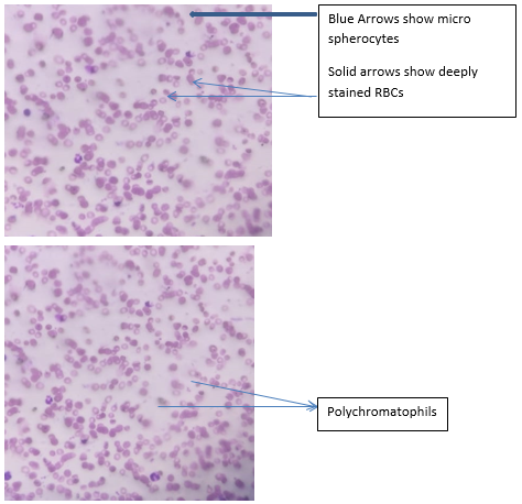 a): PBF of Child with numerous deeply stained RBCs and microspherocytes. (10 X 40 magnification);  b): PBF of Child with Polychromasia. (10 X 40 magnification)