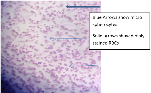 PBF of mother showing l deeply stained RBCs and microspherocytes (10 X 40 magnification)