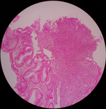 Non-Hodgkin’s Lymphoma Stomach H&E Stain (10X)