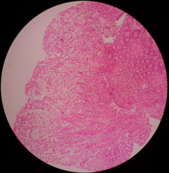 Signet Ring Adenocarcinoma Stomach H&E Stain (10X)