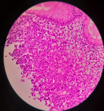 Poorly differentiated Adenocarcinoma H&E Stain (10X)
