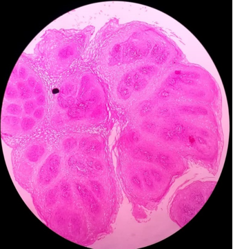 Squamous papilloma H&E Stain (10X)