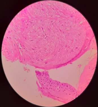 Gastro-intestinal Stromal Tumour (GIST) H&E Stain (40X)