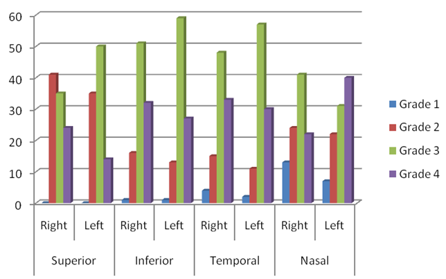 Gonioscopic findings of grading of angle in right eye and left eye