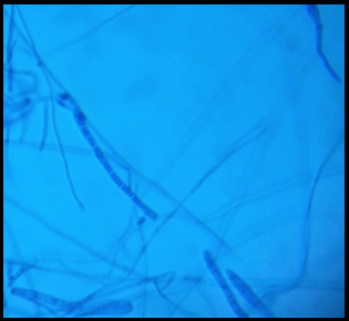 LCB mount of T. rubrum; T. rubrum showing long, pencil shaped macroconidia (40X)